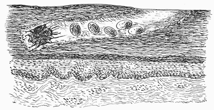 Sarcoptes scabiei. Diagrammatic representation of the course in the skin of man