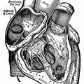 The right auricle and ventricle laid open