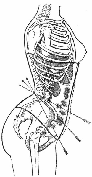 Diagram showing the action of the straight front corset