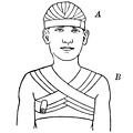 A, Recurrent bandage of the head - B, anterior figure-of-eight bandage of the chest